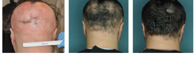 Drug Trial Restores Hair In Alopecia Areata Sufferers