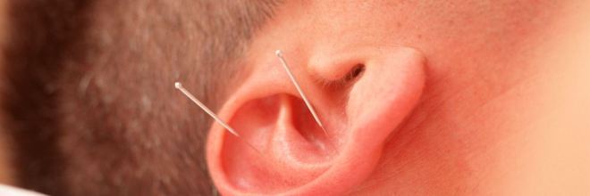 Stimulating Ear With Acupuncture Might help Weight reduction